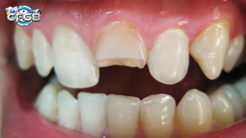 Nằm mơ thấy rụng răng ở hàm trên